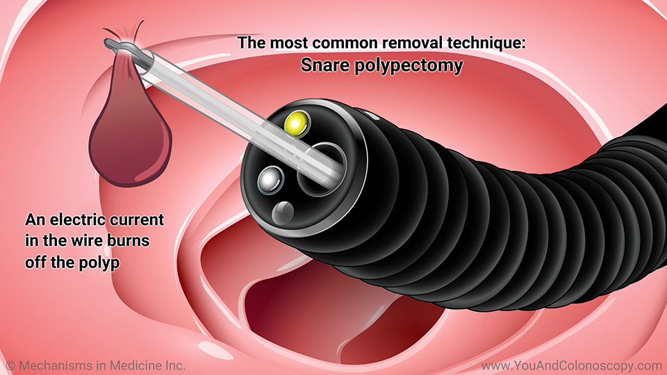 What happens during and after a colonoscopy?
