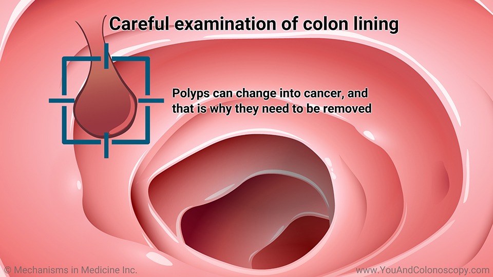 What Happens During And After A Colonoscopy 