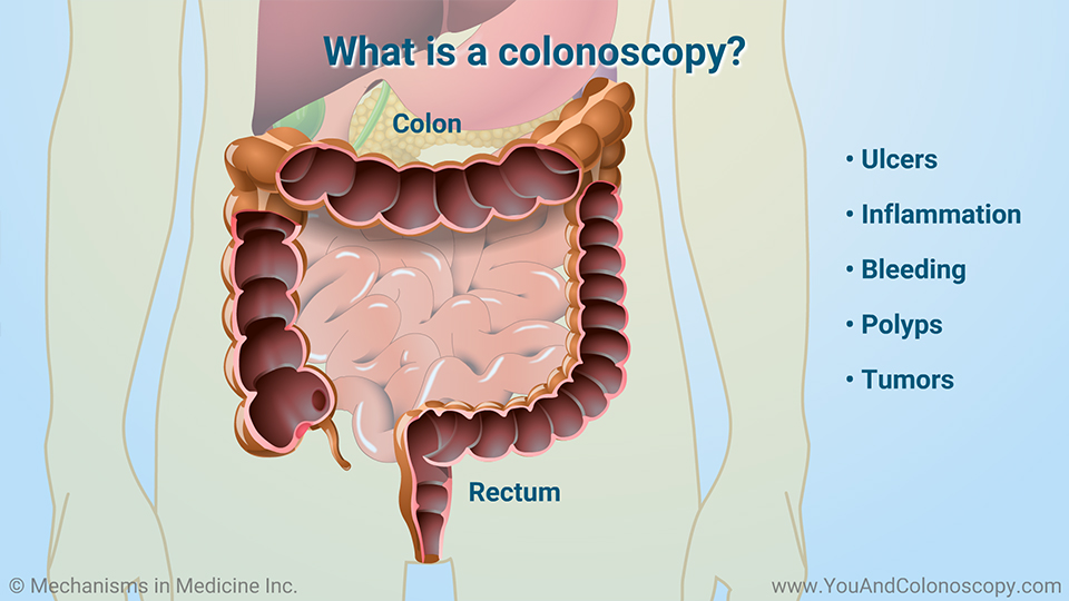 Slide Show What Happens During And After A Colonoscopy 