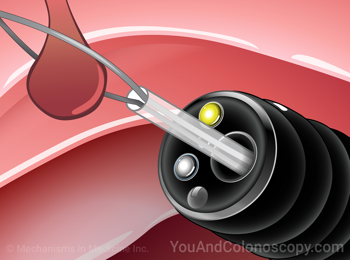 Learn about a variety of topics on colonoscopy through short animations.