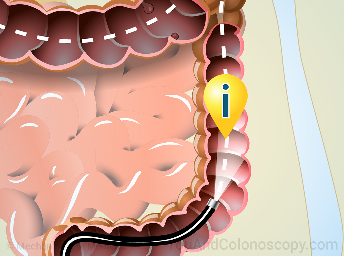 New to colonoscopy? Follow our colonoscopy visual guide!